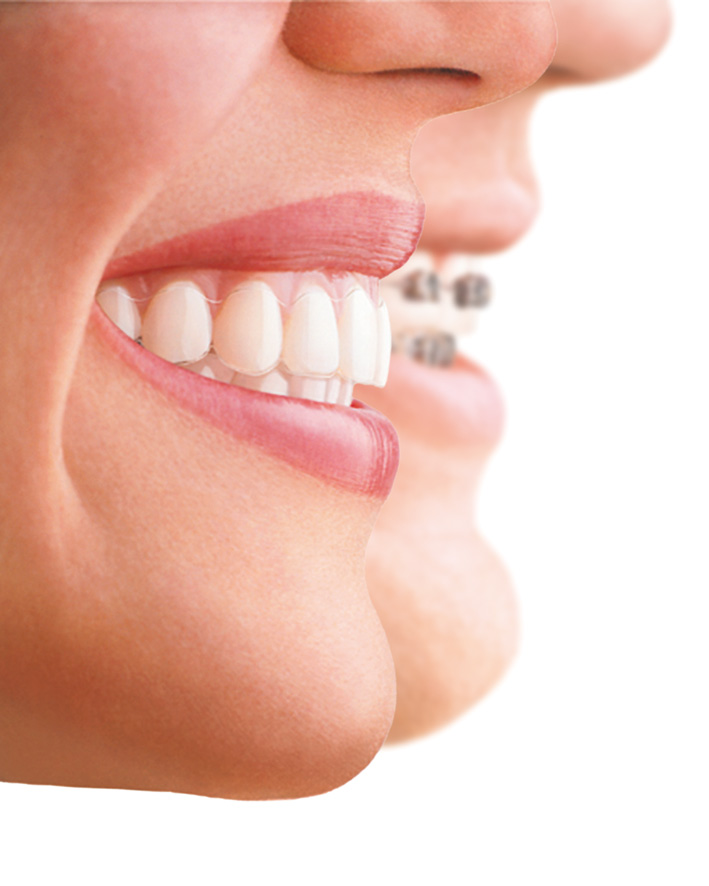 Two women wearing braces